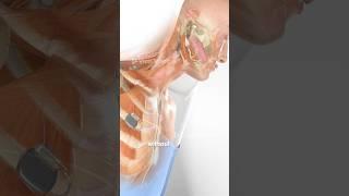 Help for sleep apnea: Hypoglossal Nerve Stimulator Implant (3D Animation)