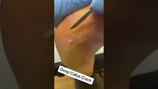 Say Goodbye to Callus Pain: Watch This Amazing Foot Transformation #Podiatrist #Skincare