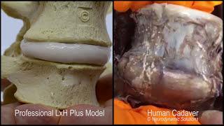 Lumbar Disc Herniation Model - Dynamic Disc Designs Corp.