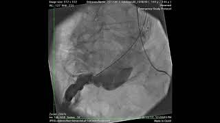 Stentgraft in Abdominal aortic Aneurysm Jotec