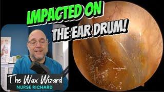 IMPACTED ON THE EAR DRUM! 377 #ear #earwax #earwaxremoval  #satisfying #foryou #fyp #foryourpage