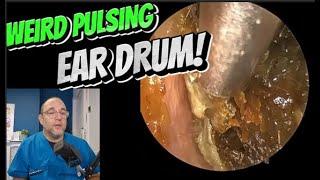 WEIRD PULSING EAR DRUM! 383 #ear #earwax #earwaxremoval #satisfying #foryou #fyp #foryourpage