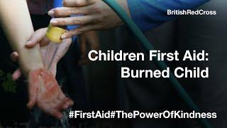 Child First Aid - Helping a child with a burn