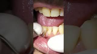 smoker’s teeth dental cleaning #shorts