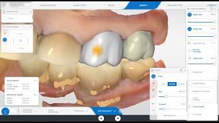 Cerec Primescan Design of Adjacent Crowns