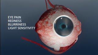 Eye redness, pain and blurred vision . UVEITIS {Eye inflammation}. #eye #uveitis