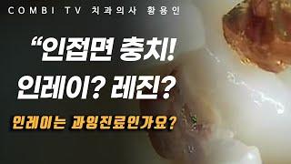 인접면 충치! 인레이 치료를 하면 과잉진료인가?