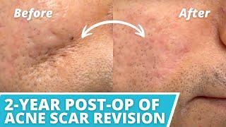 ACNE SCAR REVISION ON CHEEKS (2-YEAR POST-OP) - DR. TANVEER JANJUA - NEW JERSEY