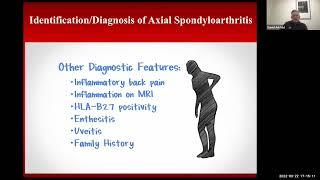 When to Suspect Ankylosing Spondylitis When a Patient Presents with Back Pain