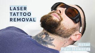 My first Laser Tattoo Removal Treatment