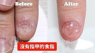 The index finger without nail｜Problematic nail treatment｜Adjustment crystal nail production