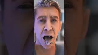 "شاب يُفجِّر وجهه بعلكة دون أن يدري!"