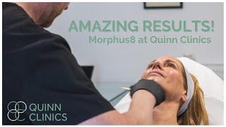 Non-Surgical Facelift? The Morpheus8 Device at Quinn Clinics Bristol! | Inmode Morpheus8