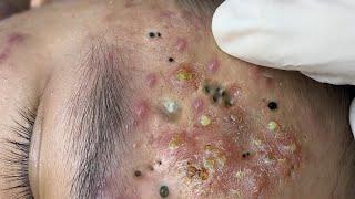 Big Cystic Acne Blackheads Extraction Blackheads & Milia, Whiteheads Removal Pimple Popping # 1594