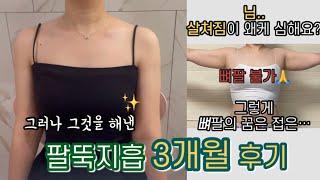 팔뚝지방흡입 3개월 차 후기 | 살쳐짐 후기, 둘레, 팔뚝 변천사, 지흡후기