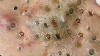 Massive Blackheads Removal #30