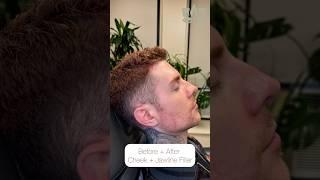 Before + After: Cheek + Jawline Filler