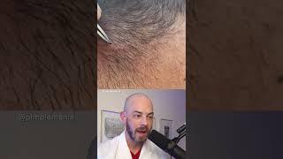 Derm reacts to BIG ingrown hair! #dermreacts #doctorreacts #ingrownhair