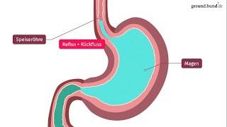 Was ist die Refluxkrankheit?