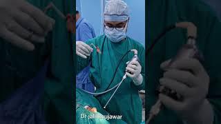 AC polyp .endoscopic removal.Dr jalil mujawar