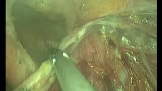 Dr. Mohamed Shehata, Laparoscopic Inguinal Hernia Repair TAPP, Tanta University, Egypt