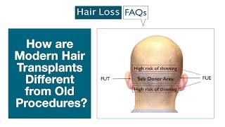 How are Modern Hair Transplants Different from Old Procedures?