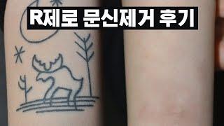 한 번에 최대 4회 제거 효과 | R제로 문신제거후기 | 타투제거후기 | 문신지우기