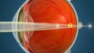 How Orthokeratology Works