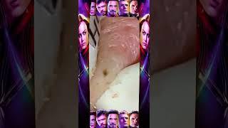 Big Cystic Acne Blackheads Extraction Blackheads & Milia, Whiteheads Removal Pimple Popping #PA211