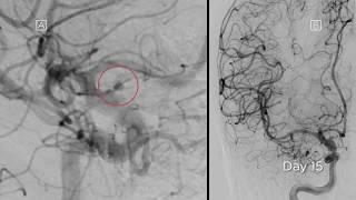 #radialfirst treatment of a blister-like aneurysm