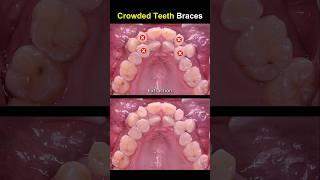 Complex braces for crowded teeth #braces #orthodontist #dentist