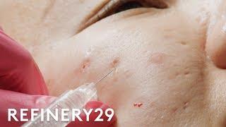 I Got Fillers For My Acne Scars | Macro Beauty | Refinery29