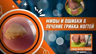 Мифы и ошибки в лечение грибка ногтей. Грибок ногтей у ребенка. Что делать? #грибокногтей #дети #миф