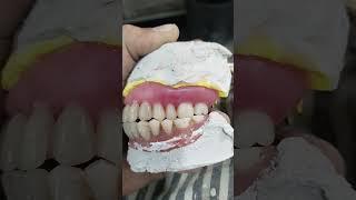 Upper Removable Partial Denture Ready For Flasking 