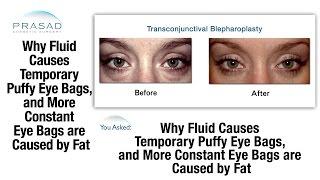 How Fluid Causes Temporary Puffy Eyes, and Why Constant Eye Bags are Caused by Fat