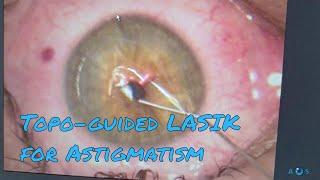 Contoura Vision: Laser Eye Surgery for Astigmatism ( Topography-guided LASIK, PRK)