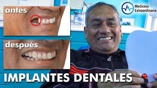 SE COLOCÓ IMPLANTES DENTALES y CAMBIÓ su VIDA  DR. YURI MARTINEZ * CLÍNICA DENTAL PRODENT PERÚ