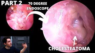 UPDATE: Infected Mastoid Cavity Condylectomy Patient Is Back (PART 2, ANGLED ENDOSCOPES)