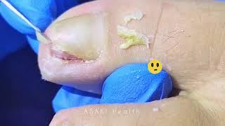 Cut Dirty Ingrown Toenail 剪大脏向内生长脚趾甲 #shorts #video #health