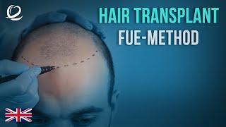 FUE Hair Transplantation Method at Clinicana Istanbul, Turkey