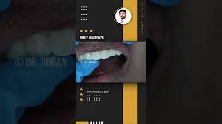 Smile Makeover | Dr. Jibran