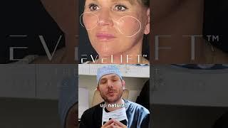 Before and After Facial Rejuvenation | Eden Plastic Surgery: Dr. Ali Charafeddine, MD