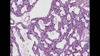 Histopathology Lung --Interstitial pneumonia