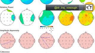 آشنایی با نقشه مغزی(QEEG)