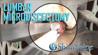 Lumbar Microdiscectomy