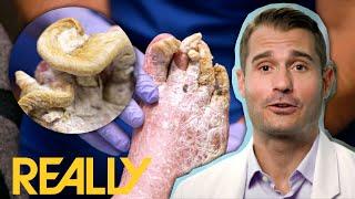 "This Is The Worst Case Of Toe Nail Fungus That I've Seen" | My Feet Are Killing Me