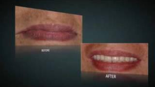 Teeth in an Hour?