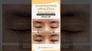 A revision surgery without the "two line method"? Don't get a new eyelid scar that you don't need!