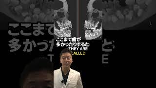 過剰歯と呼ばれるものです #歯列矯正 #蒲田 #歯医者 #矯正 #dentist