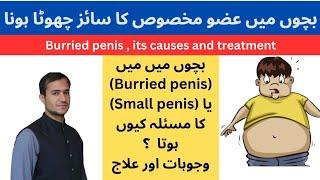 Burried Penis- Bachon mn penis size ka chota hona- causes and treatment-Urdu  hindi- home tips